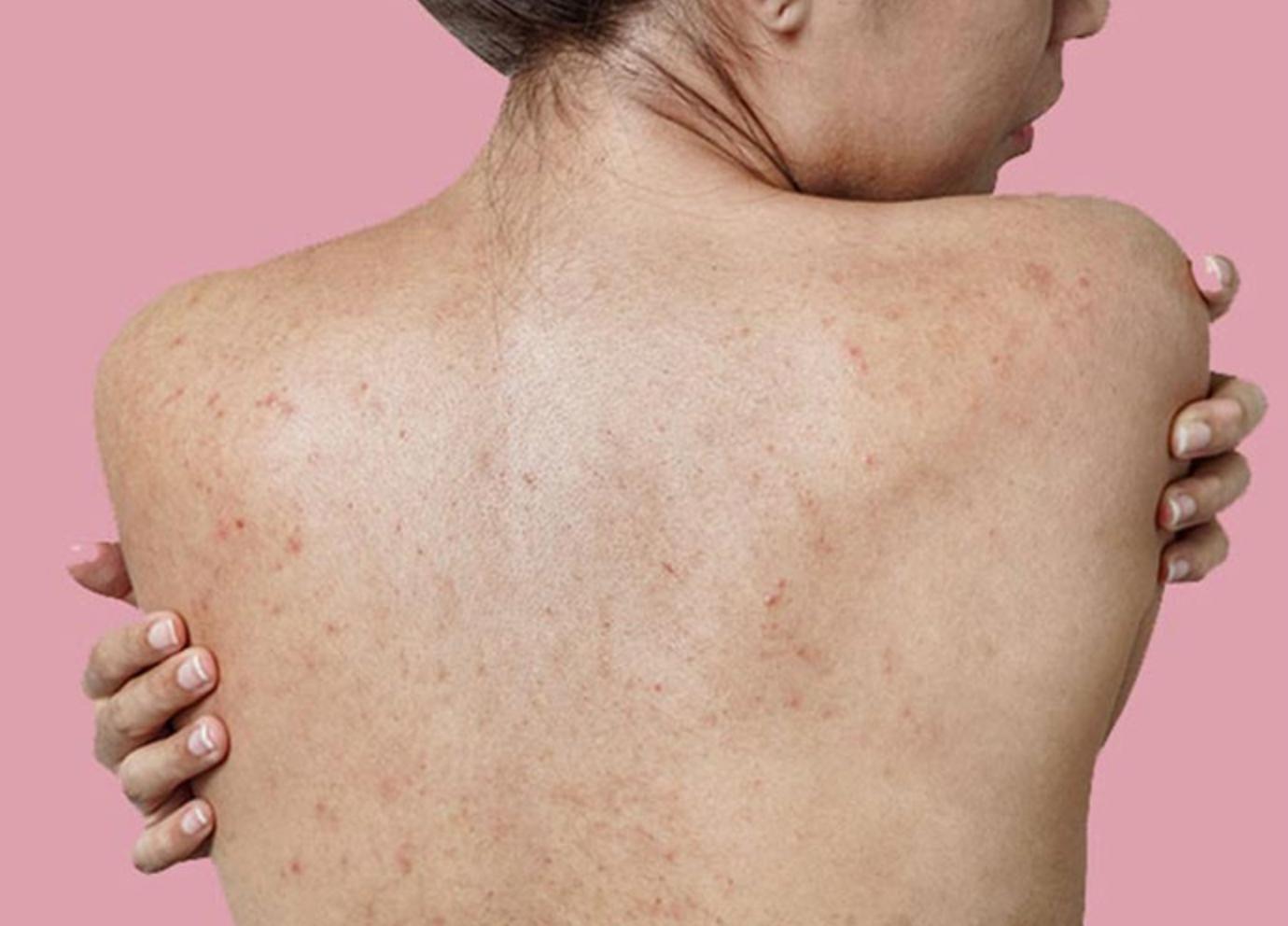Body Skin Rejuvenation