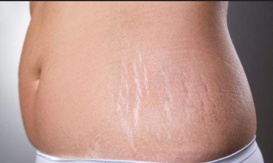 Stretch Marks Treatment