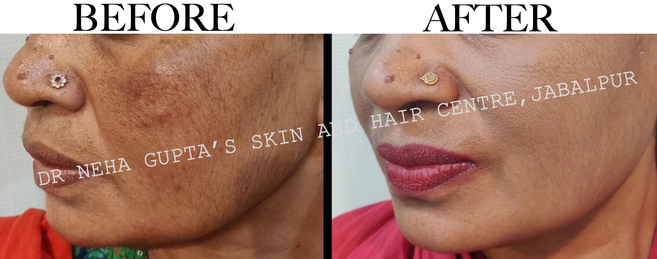 Pigmentation Treatment before and after