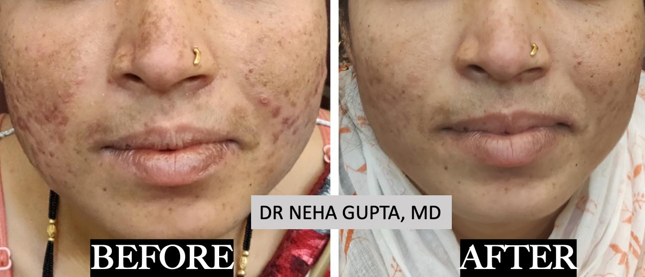 Acne & Melasma Treatment before and after