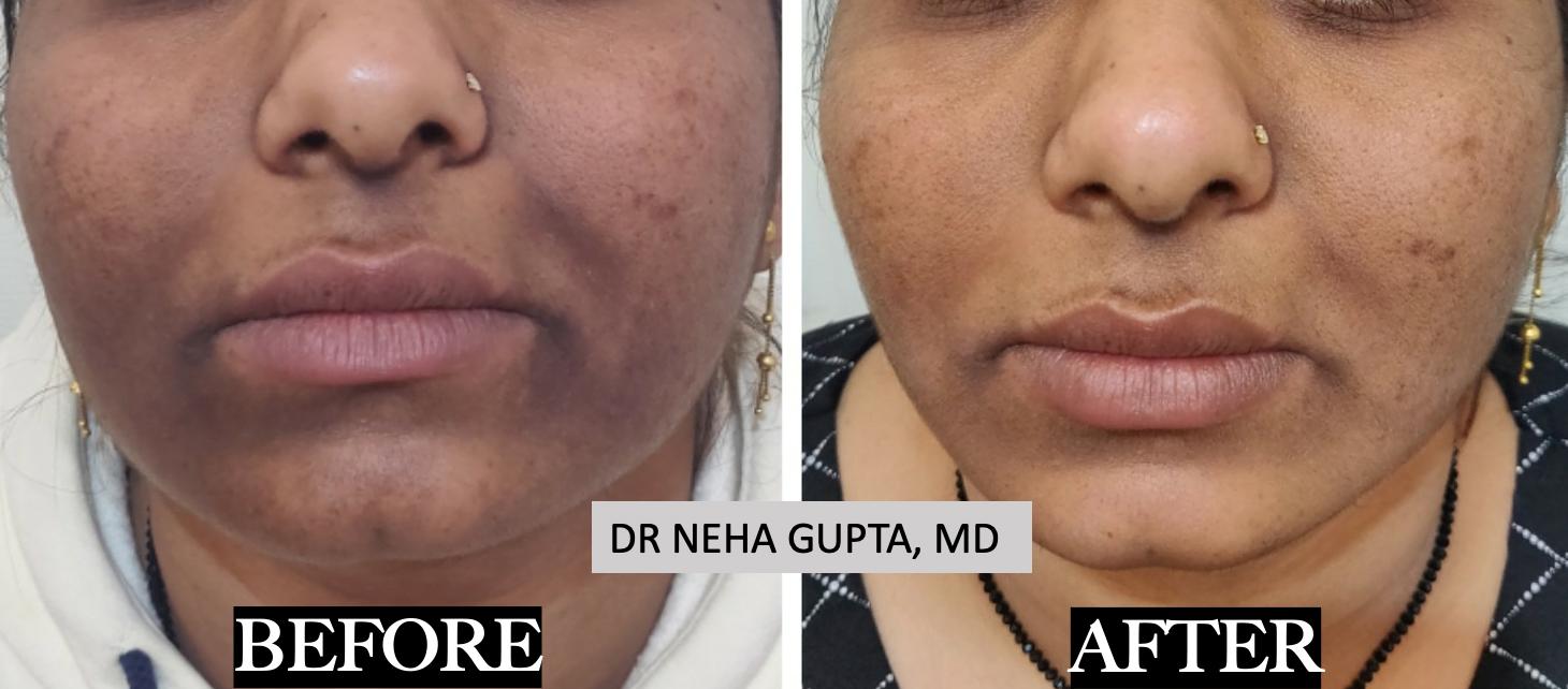 Pigmentation Treatment before and after