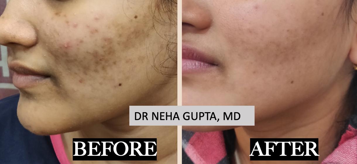 Acne Treatment before and after