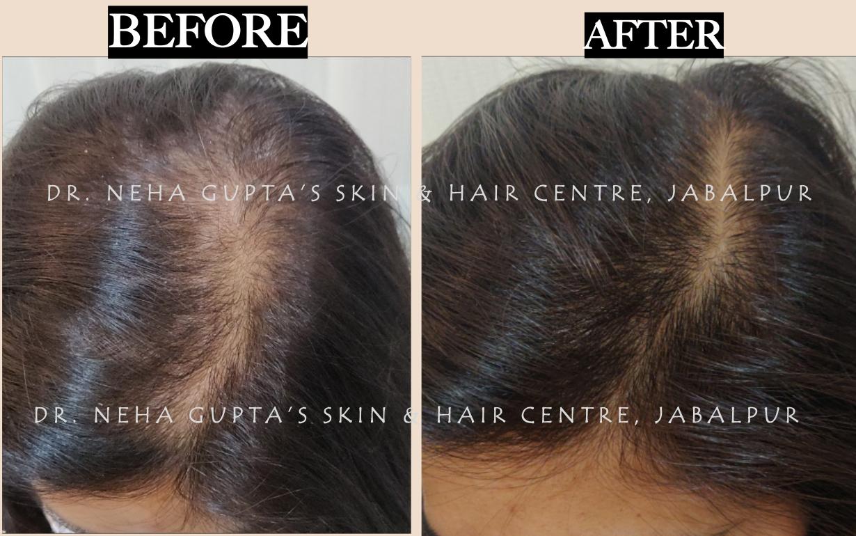 Hair Restoration before and after