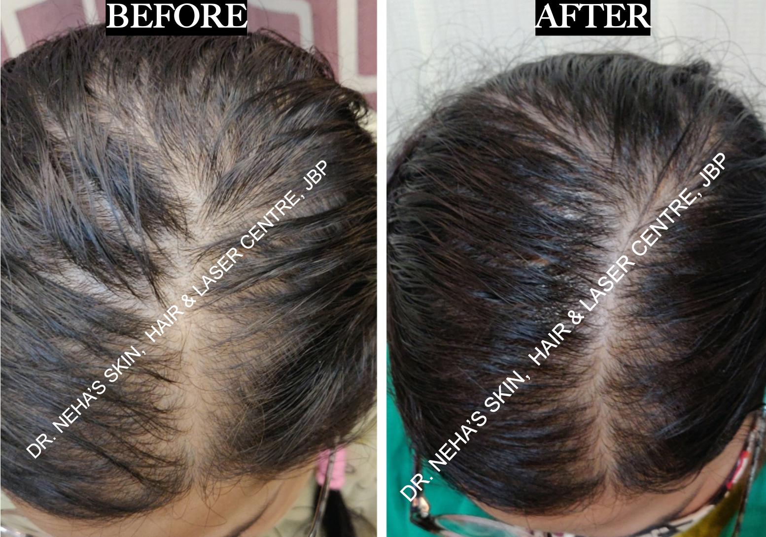 Hair Restoration before and after