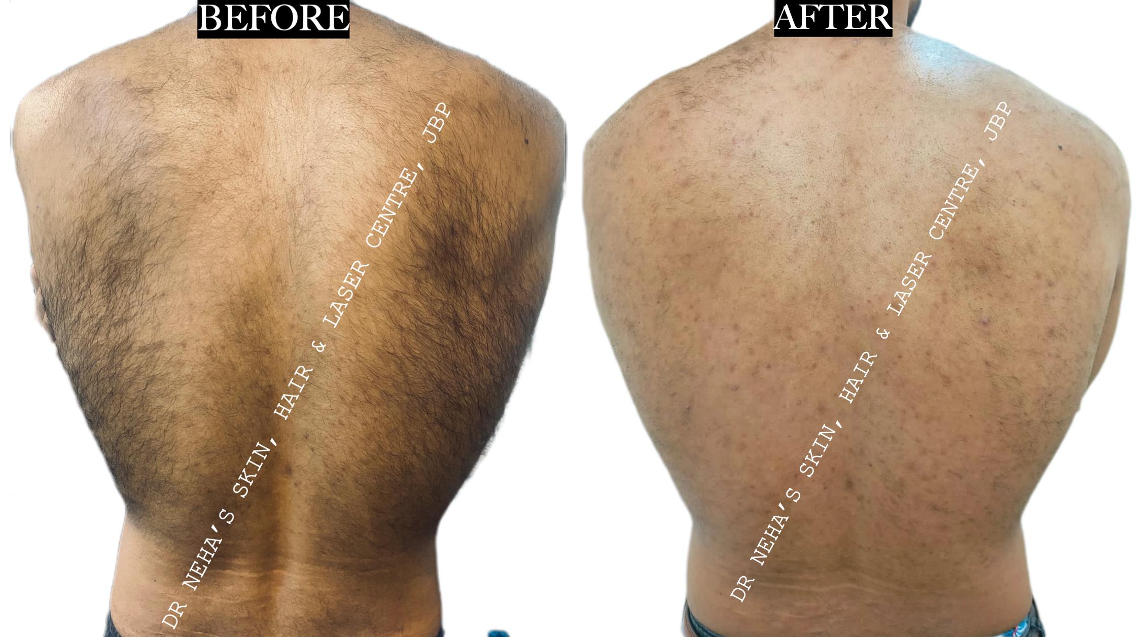 Body Rejuvenation & Laser Hair Removal before and after