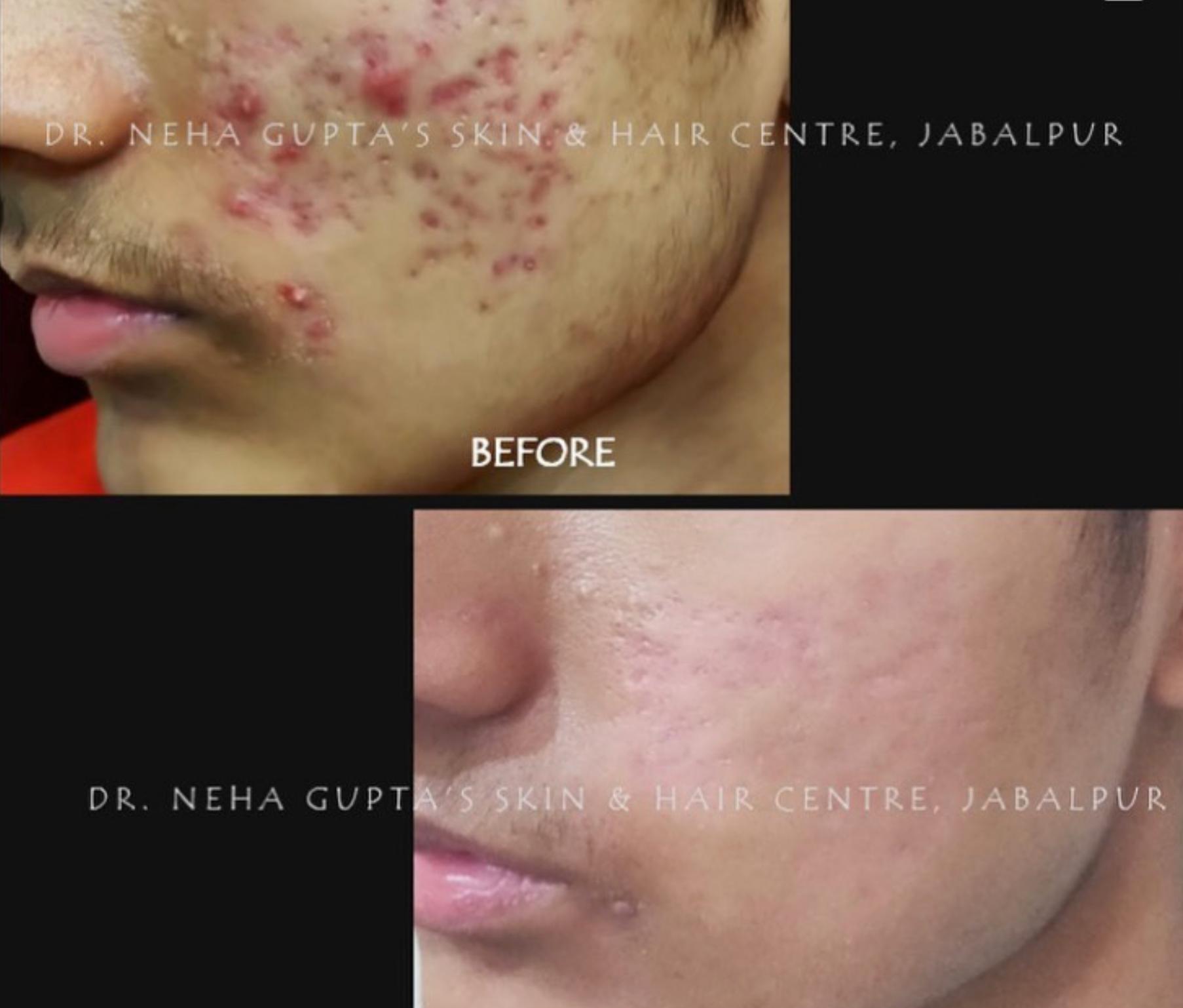 Acne & Scar Treatment before and after
