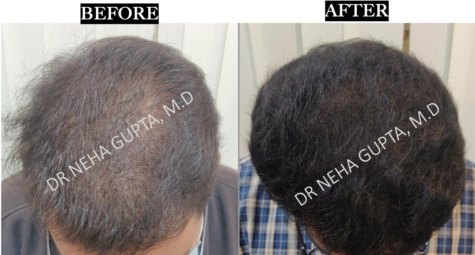 Non-Surgical Hair Restoration before and after