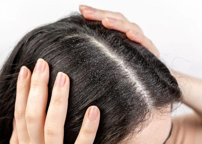 Dandruff & Scalp Issues
