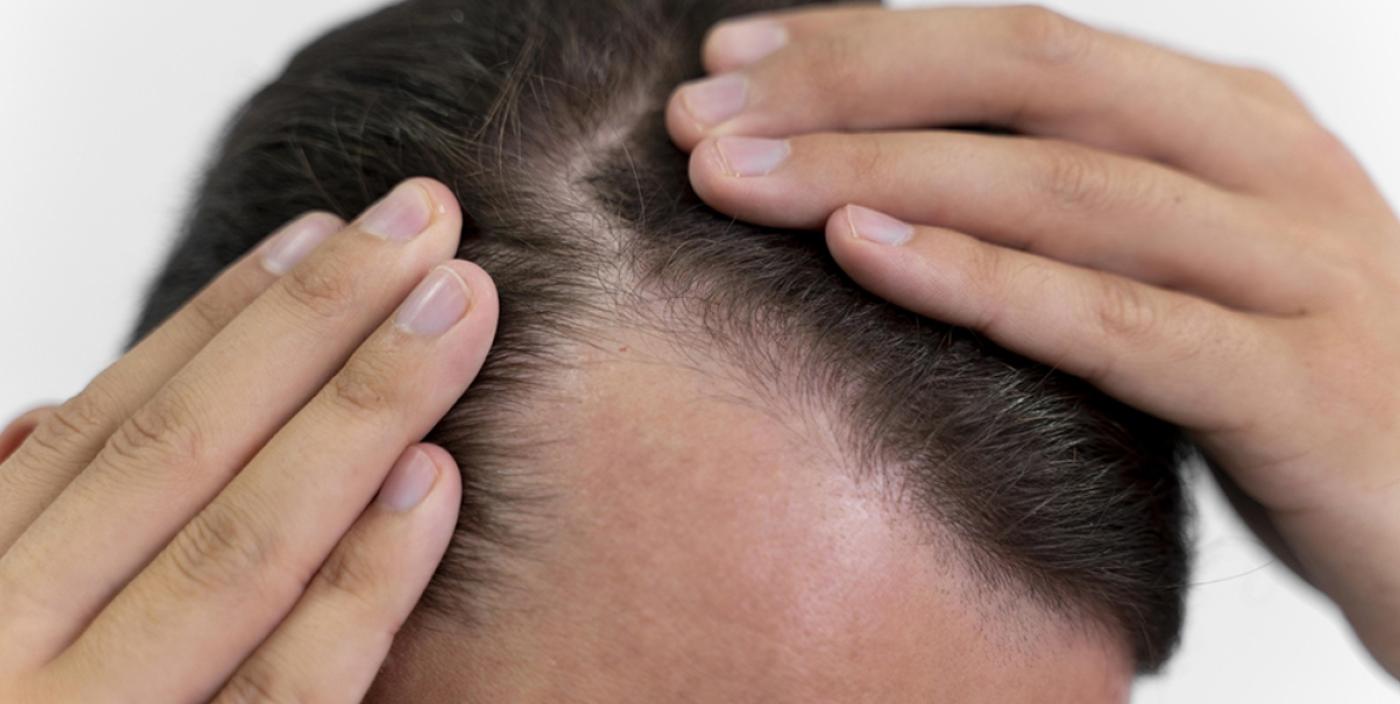 Pattern Baldness
