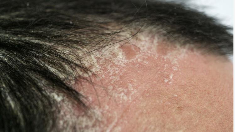 Scalp Psoriasis