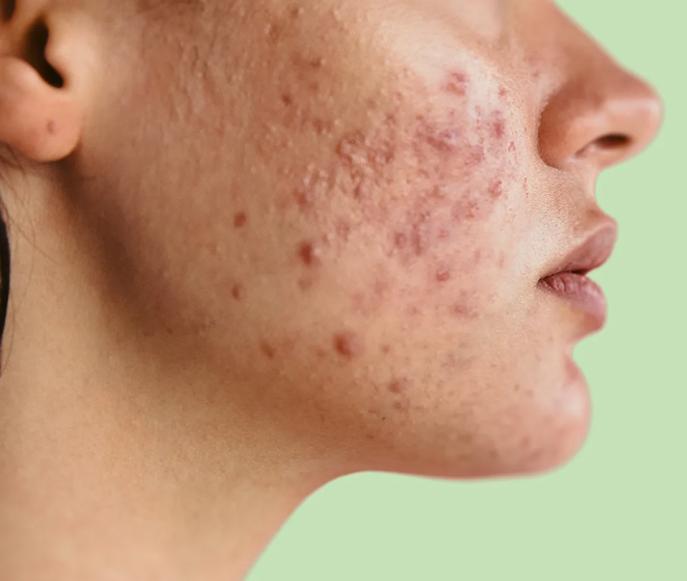 Acne & Scars