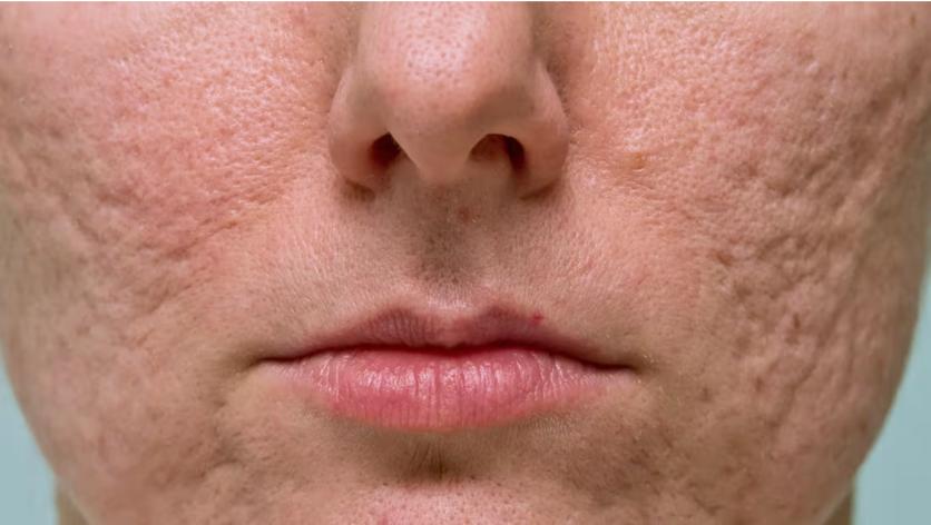 Acne Scars & Marks
