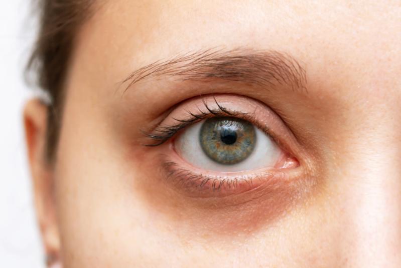Dark Circles