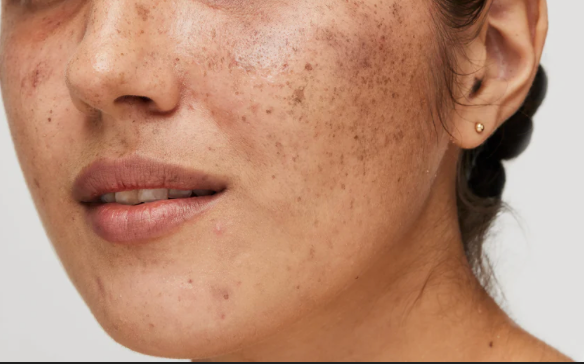 Pigmentation