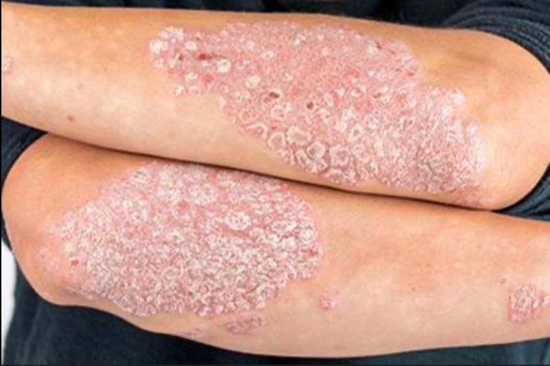 Psoriasis