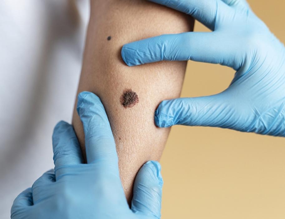 Skin Tags, Moles & Warts