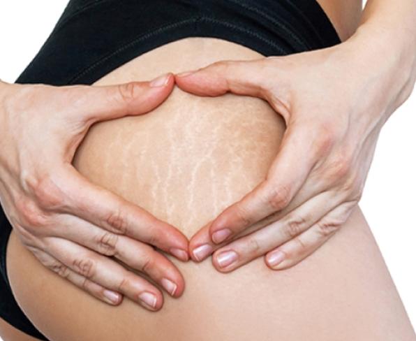Stretch Marks
