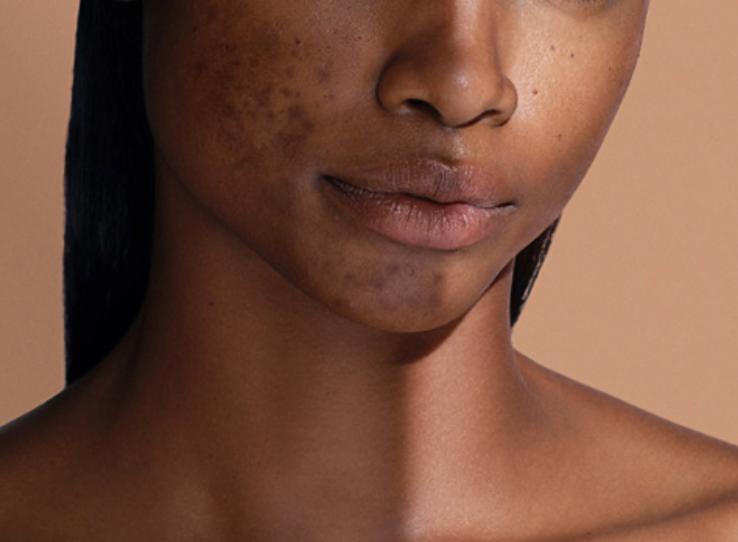 Pigmentation treatment for skin of color