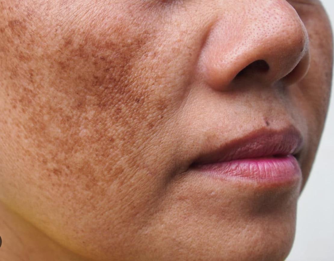 Melanin-rich skin specialized care
