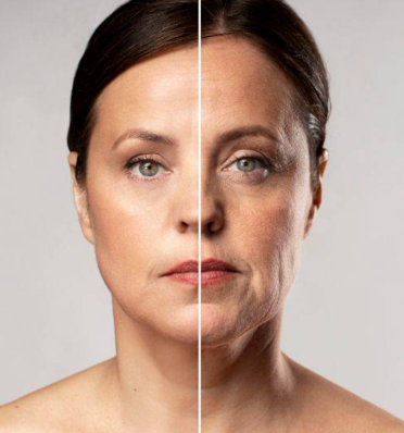 Non-Surgical Facelift