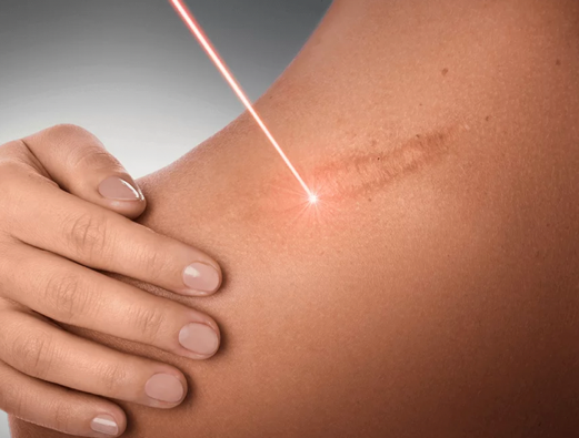 Scar Reduction