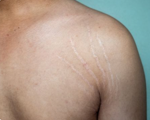 Stretch Marks Treatment