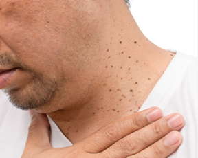 Skin Tag/Mole Removal