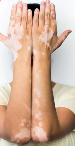 Vitiligo Treatment