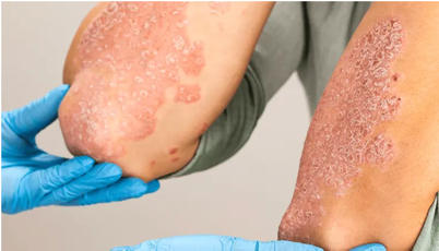 Psoriasis Management