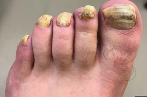 Nail Infections Treatment